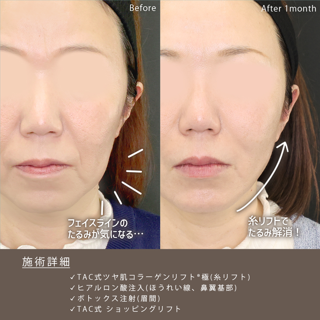 TAC式 ツヤ肌コラーゲンリフト®/TAC式 ショッピングリフト/ほうれい線のヒアルロン酸注射の症例写真 施術前後
