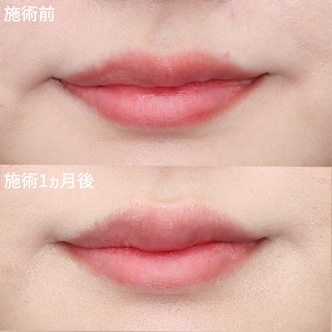 口角挙上・リフト（マイクロ切開法・内側法/口内法）/ヒアルロン酸注射：その他の症例写真 施術前後 