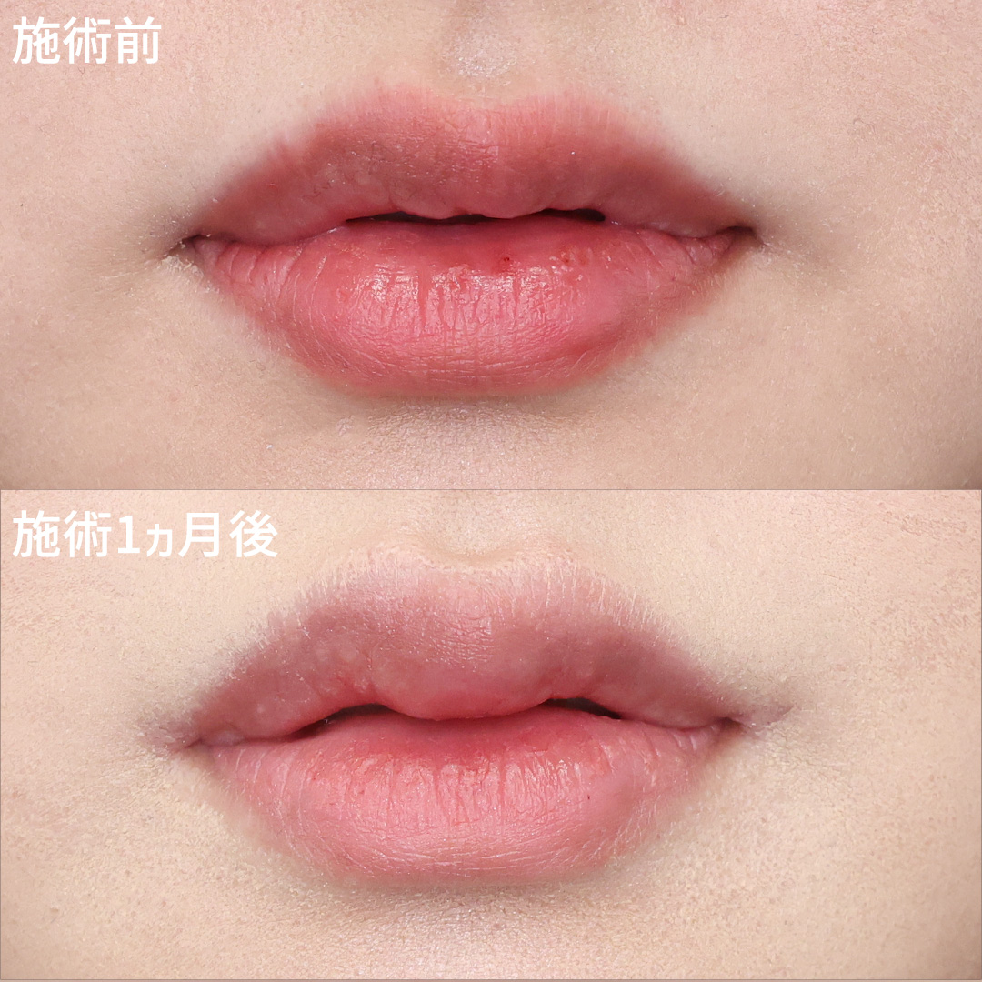 口角挙上とスマイルリップでセクシーな印象の口元に