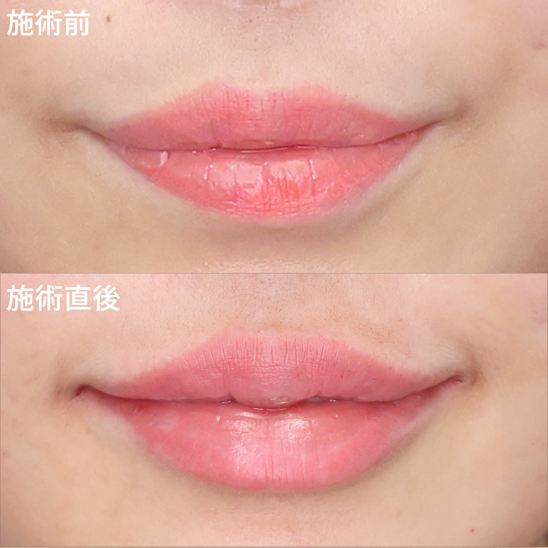 口角アップしてスマイルリップに！唇ヒアルと口角ボトックスの組み合わせ♡