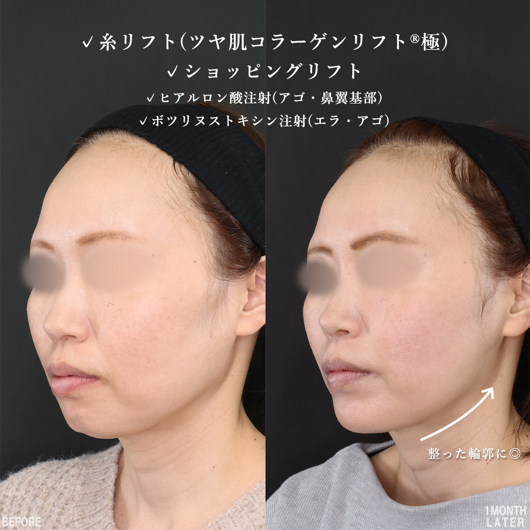 TAC式 ツヤ肌コラーゲンリフト®/TAC式 ショッピングリフト/顎のヒアルロン酸注射の症例写真 施術前後