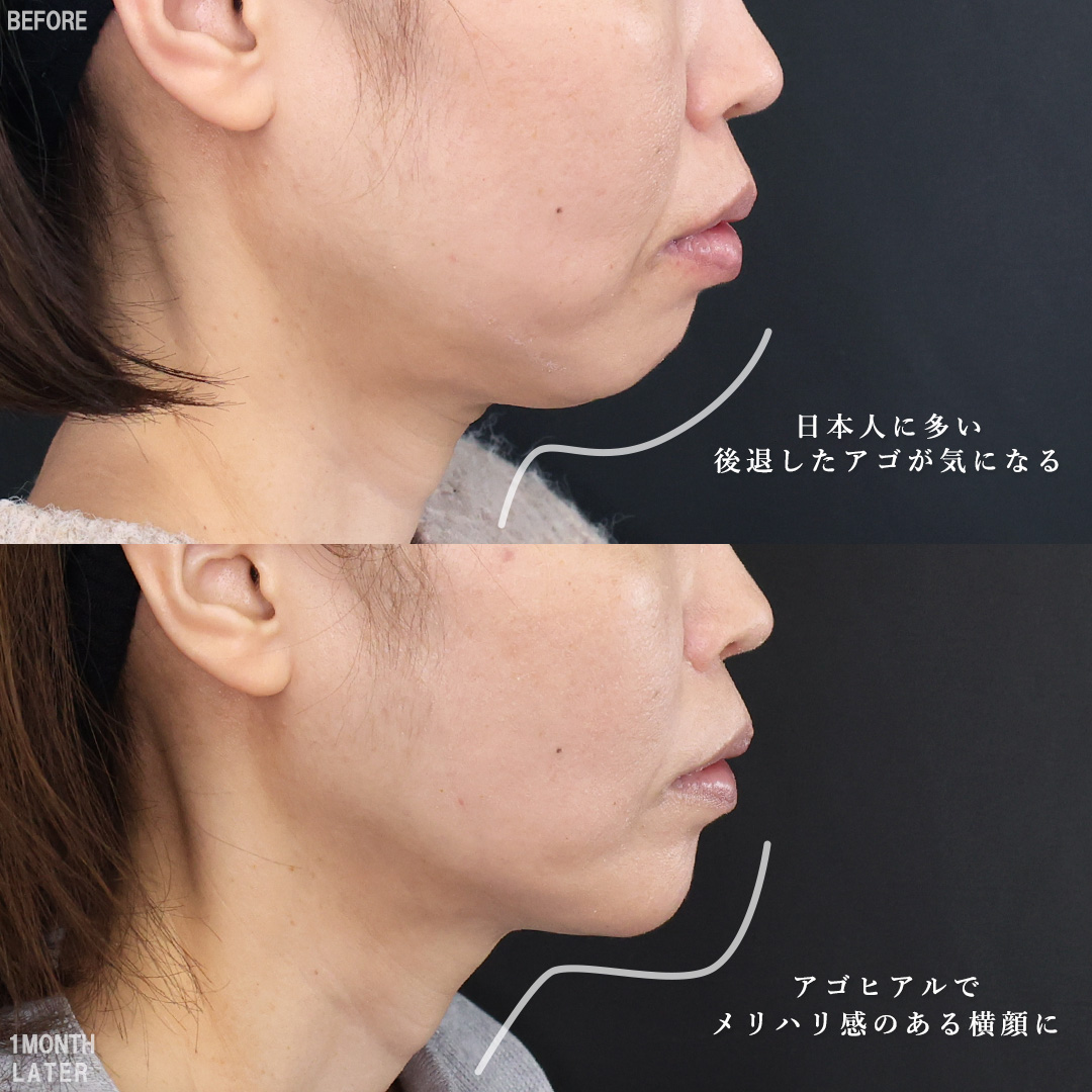 TAC式 ツヤ肌コラーゲンリフト®/TAC式 ショッピングリフト/顎のヒアルロン酸注射の症例写真 施術前後