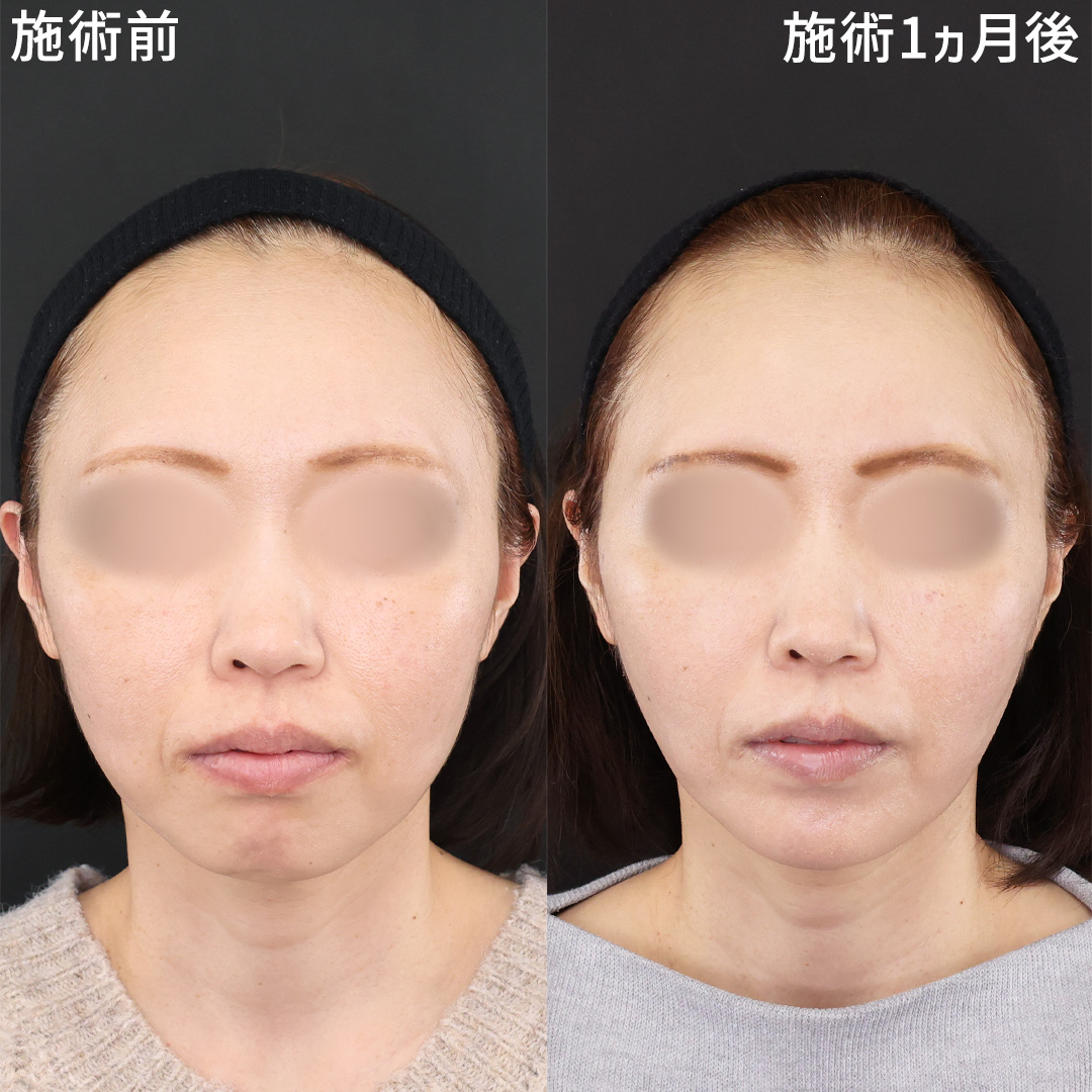 40代若返り｜糸リフトでたるみ解消