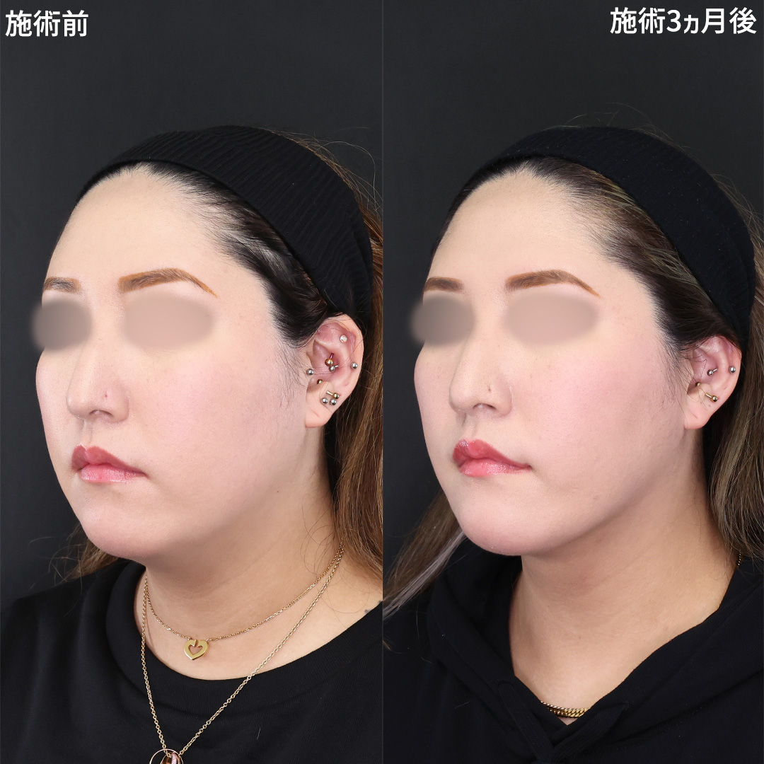 【脂肪吸引×糸リフト】二重アゴ解消！スッキリ小顔に