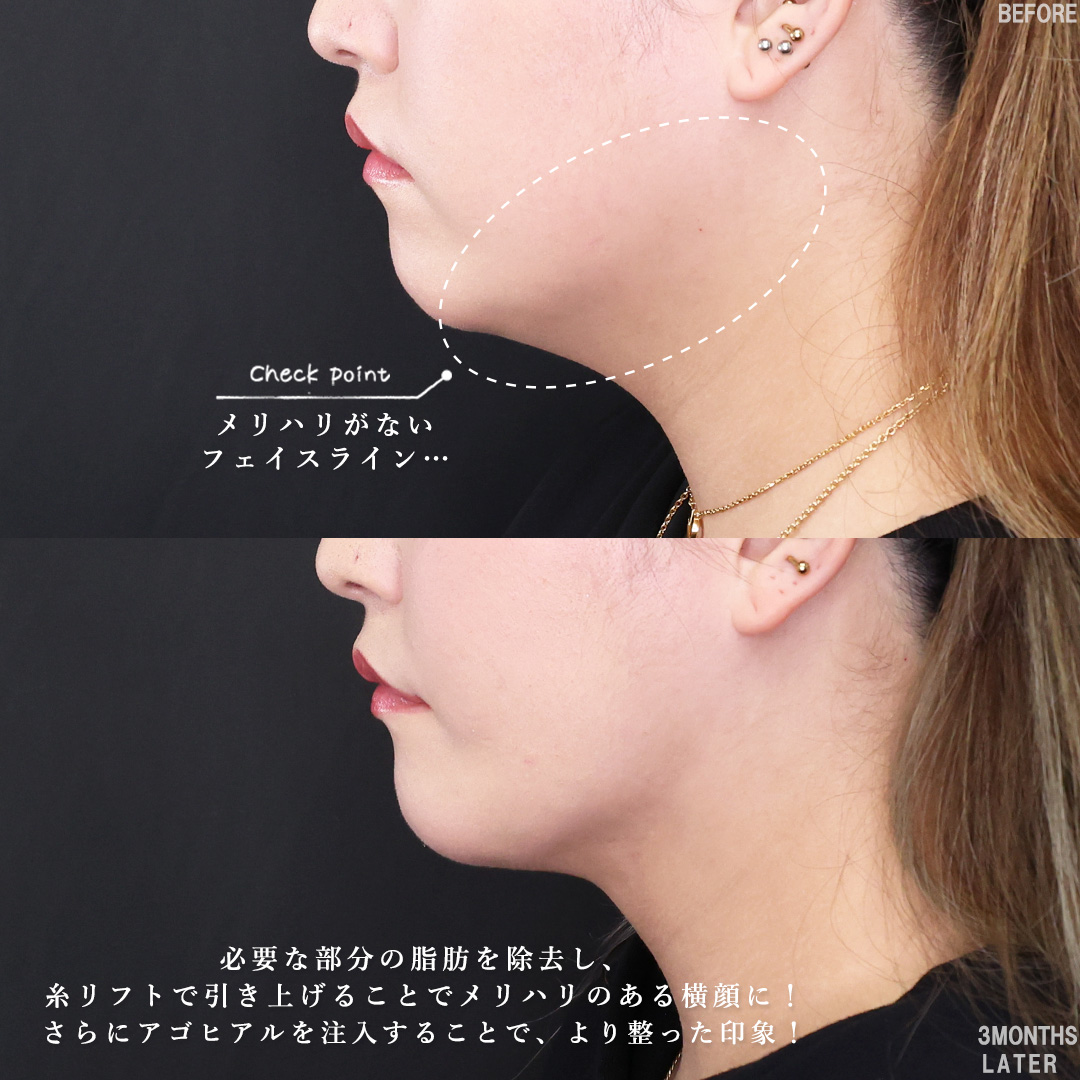 TAC式 ツヤ肌コラーゲンリフト®/Lラインファット除去（エラ下脂肪除去）/ジョールファット除去の症例写真 施術前後 