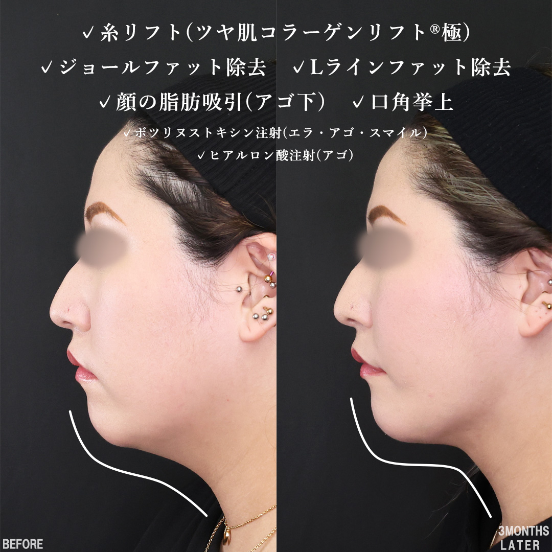 TAC式 ツヤ肌コラーゲンリフト®/Lラインファット除去（エラ下脂肪除去）/ジョールファット除去の症例写真 施術前後 