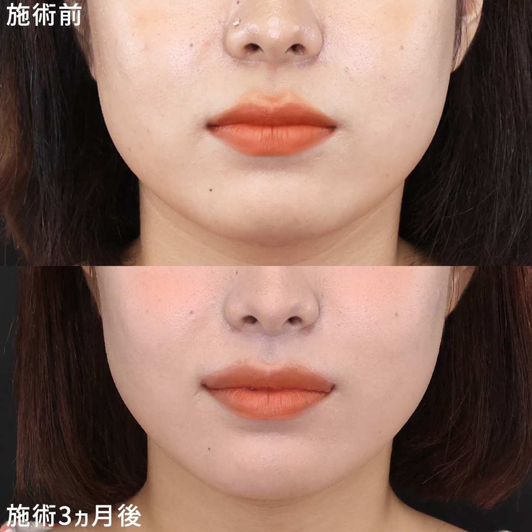 【人中短縮×口角挙上】中顔面短縮で愛され顔に！