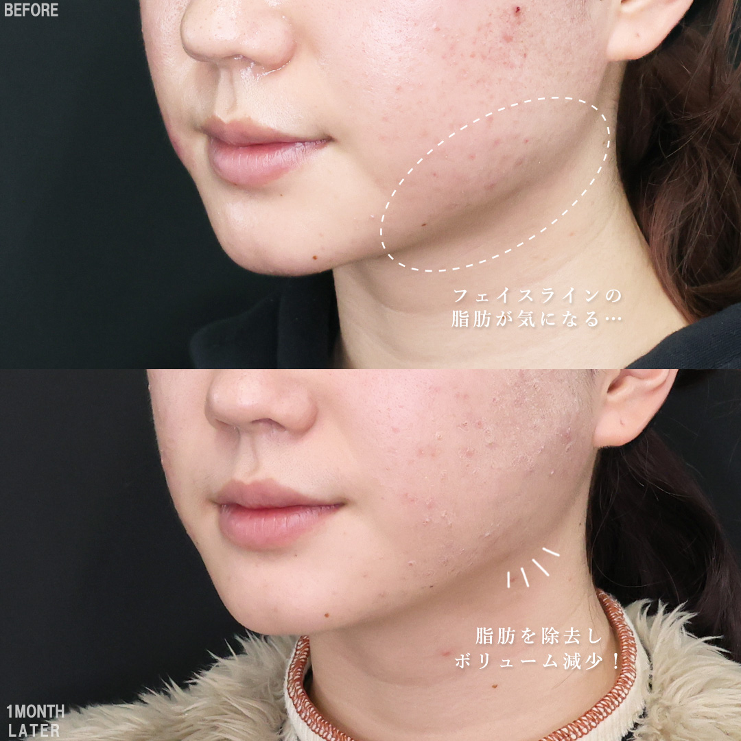 TAC式 ツヤ肌コラーゲンリフト®/エラボトックス注射/Lラインファット除去(エラ下脂肪除去)の症例写真 施術前後