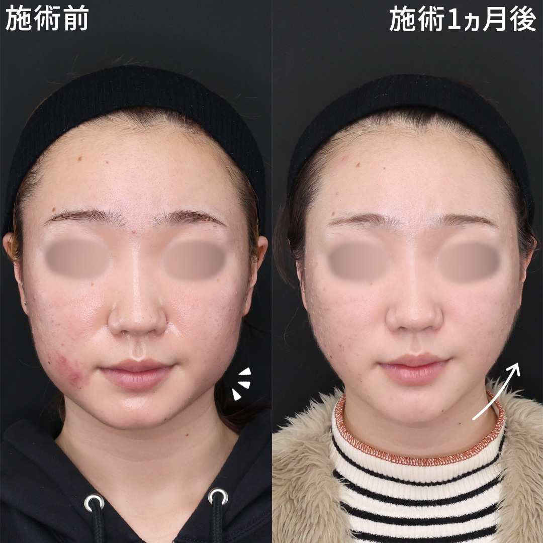 TAC式 ツヤ肌コラーゲンリフト®/エラボトックス注射/Lラインファット除去（エラ下脂肪除去）の症例写真 施術前後 