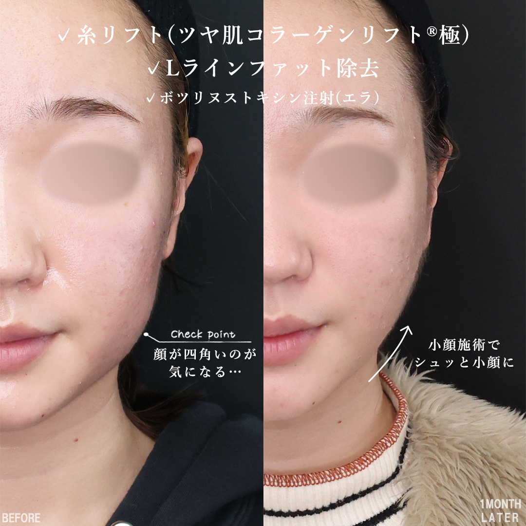TAC式 ツヤ肌コラーゲンリフト®/エラボトックス注射/Lラインファット除去（エラ下脂肪除去）の症例写真 施術前後 