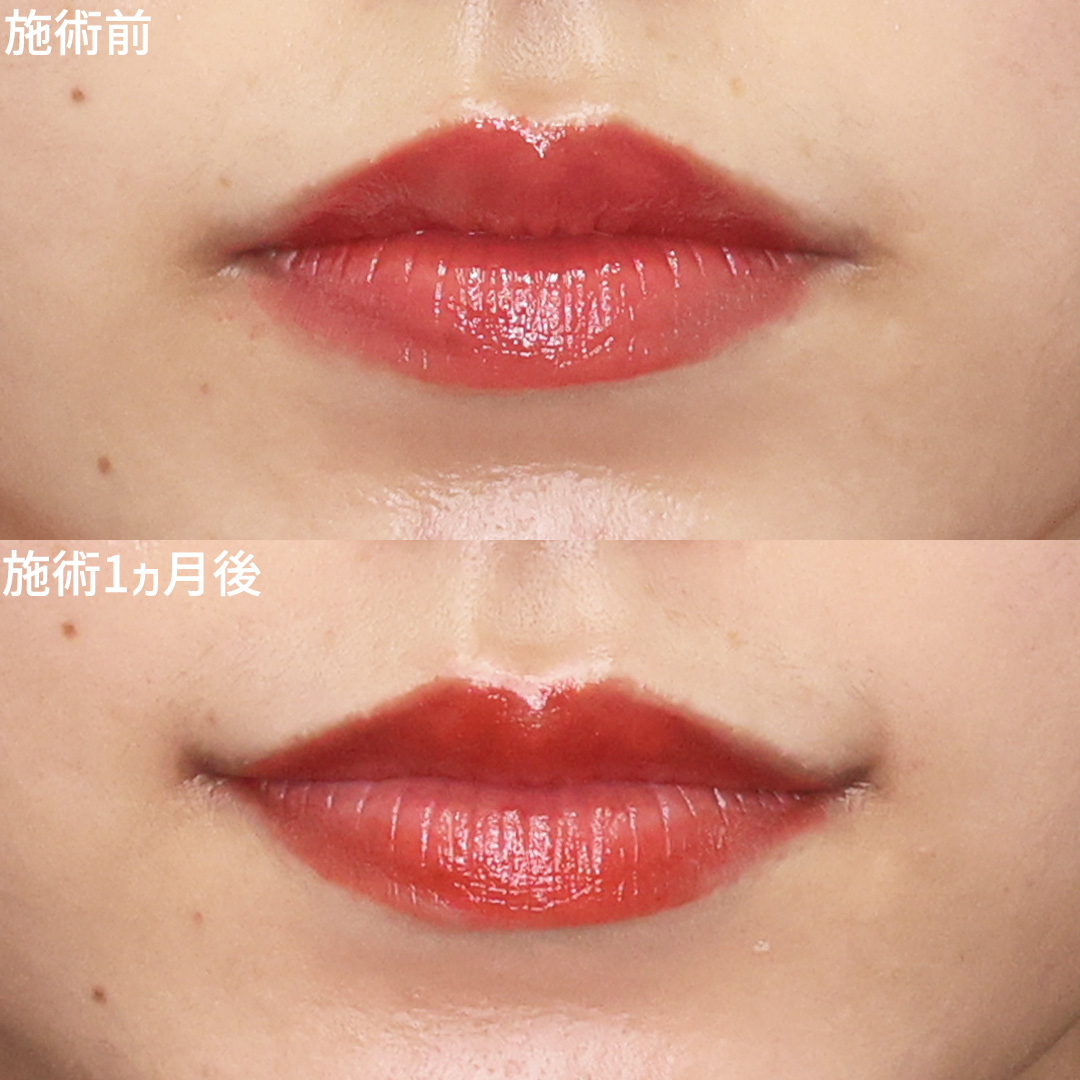 【口角挙上】明るく若々しい口元に！