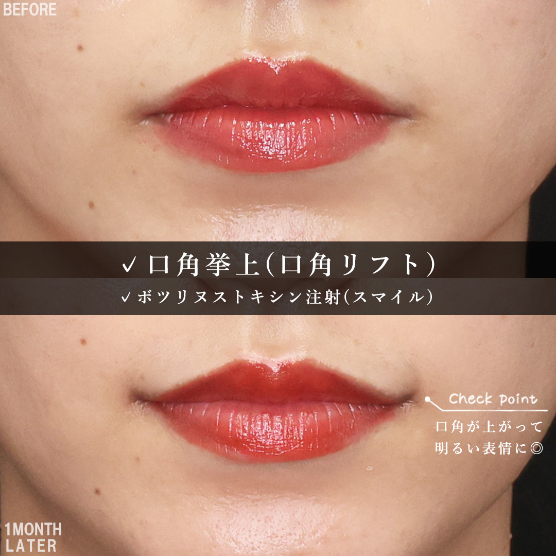 口角挙上・リフト（マイクロ切開法・内側法/口内法）/ボトックス注射：その他の症例写真 施術前後 