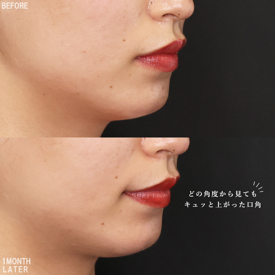 口角挙上・リフト（マイクロ切開法・内側法/口内法）/ボトックス注射：その他の症例写真 施術前後 