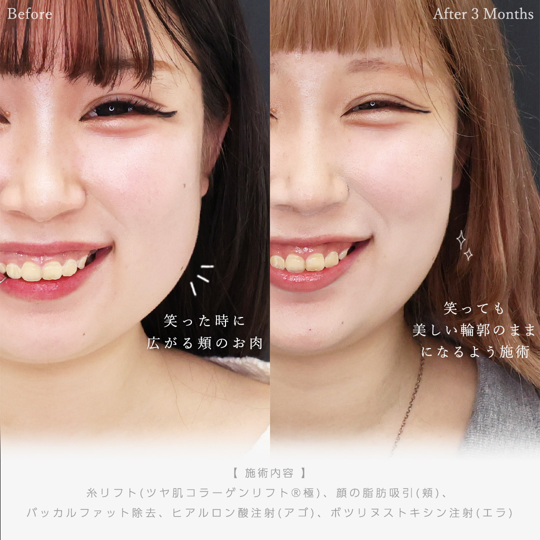 TAC式 ツヤ肌コラーゲンリフト®/顔の脂肪吸引/バッカルファット除去の症例写真 施術前後 