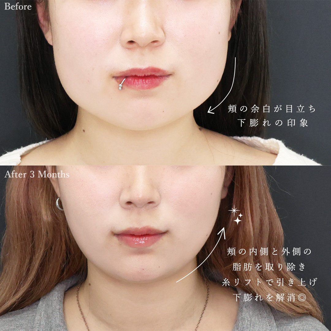 TAC式 ツヤ肌コラーゲンリフト®/顔の脂肪吸引/バッカルファット除去の症例写真 施術前後 