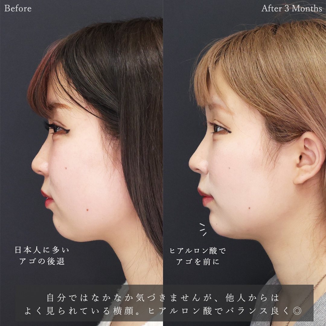 TAC式 ツヤ肌コラーゲンリフト®/顔の脂肪吸引/バッカルファット除去の症例写真 施術前後 