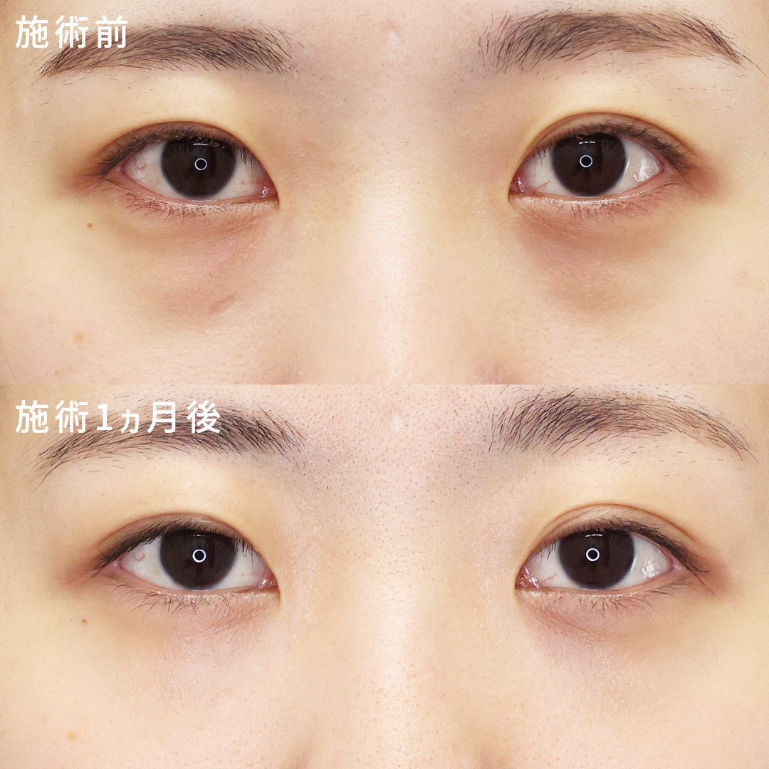 20代【目の下のクマ取り+脂肪注入】で明るい印象のお目元に