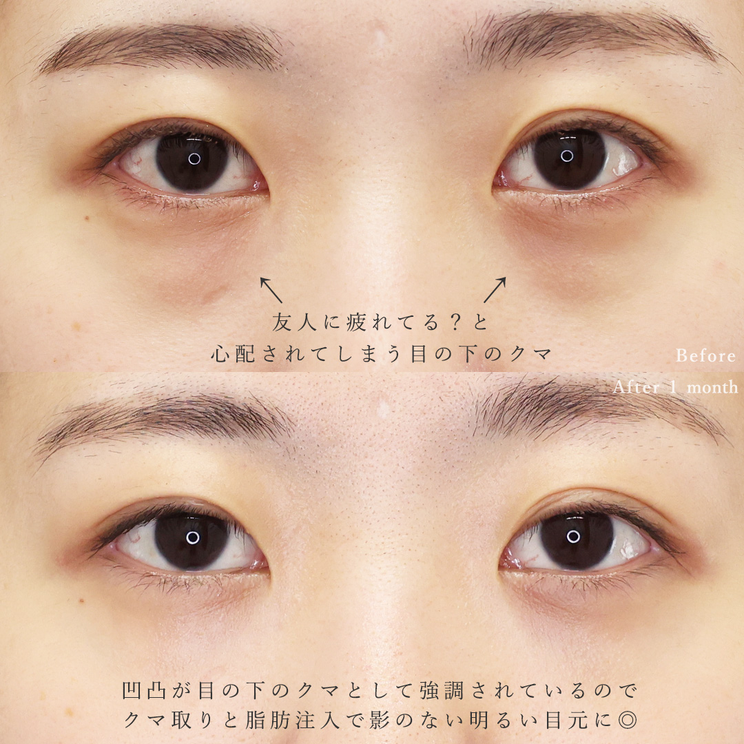 下眼瞼脱脂術（目の下のたるみ取り・目の下の脂肪ふくらみ取り）/顔の脂肪注入(コンデンスリッチフェイス)の症例写真 施術前後 