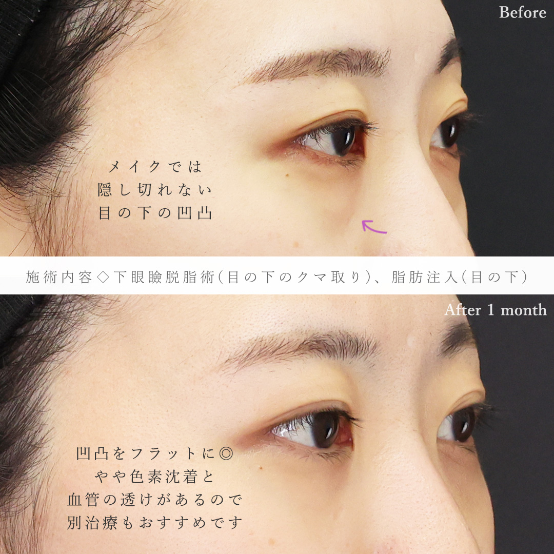 下眼瞼脱脂術（目の下のたるみ取り・目の下の脂肪ふくらみ取り）/顔の脂肪注入(コンデンスリッチフェイス)の症例写真 施術前後 