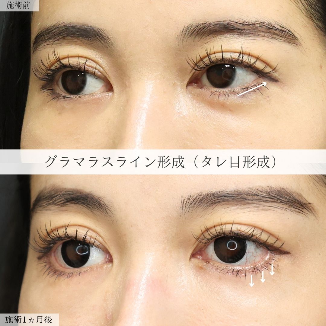 グラマラスライン(タレ目形成)の症例写真 施術前後