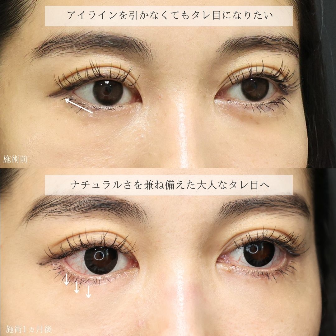 グラマラスライン(タレ目形成)の症例写真 施術前後