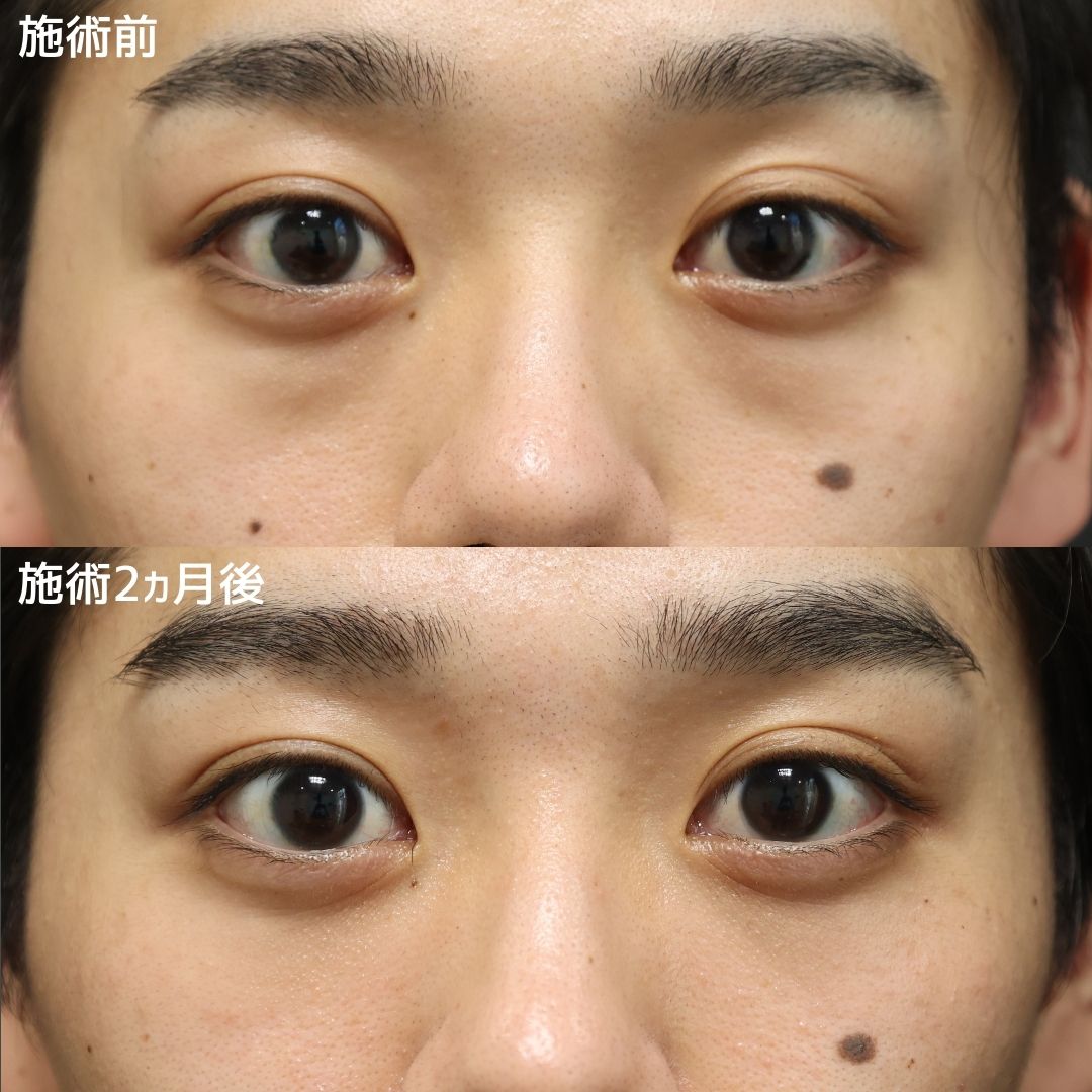 下眼瞼脱脂術(目の下のたるみ取り・目の下の脂肪ふくらみ取り)の症例写真 施術前後