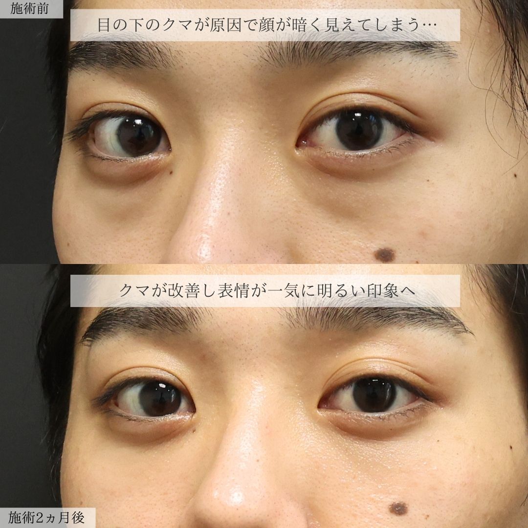 下眼瞼脱脂術(目の下のたるみ取り・目の下の脂肪ふくらみ取り)の症例写真 施術前後