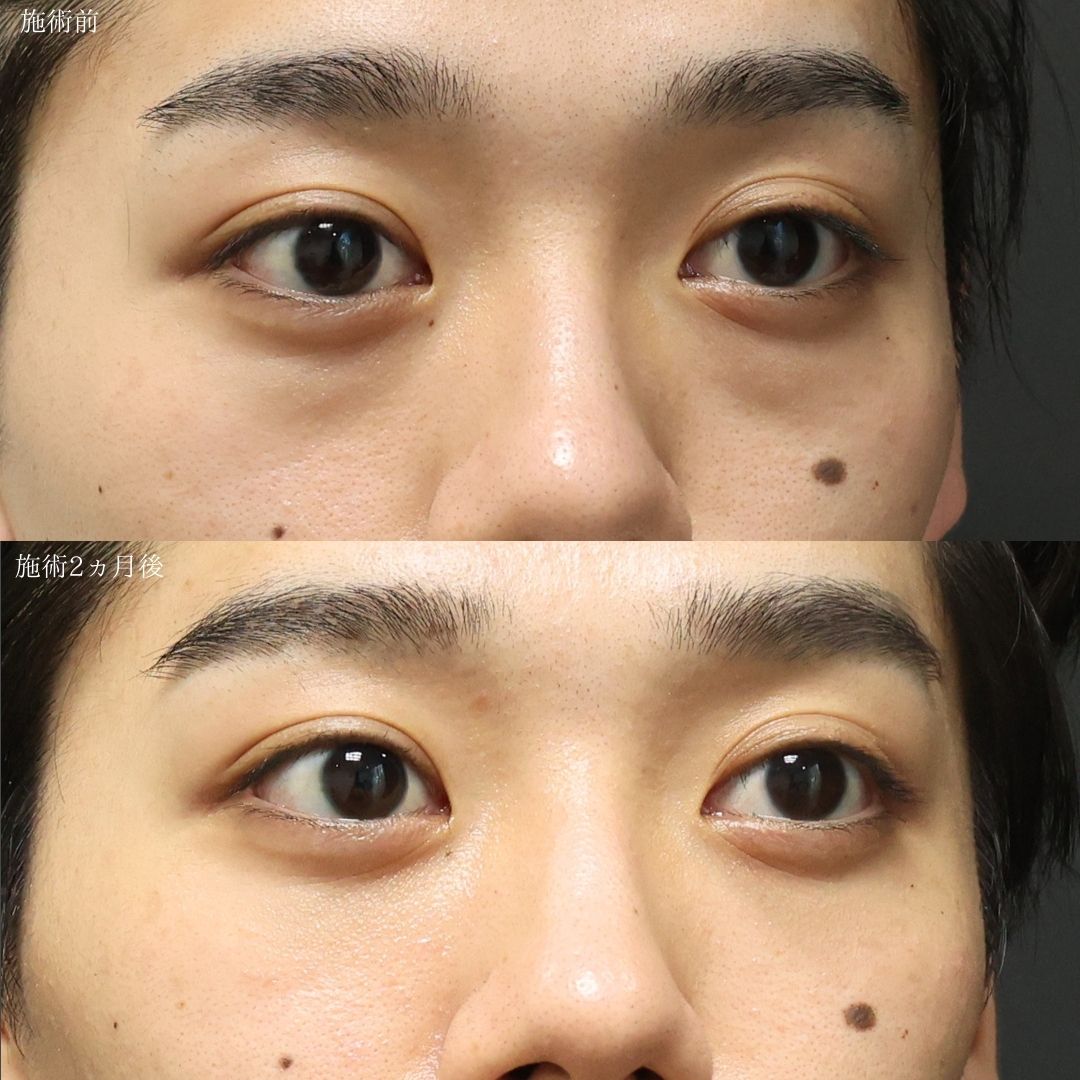 下眼瞼脱脂術(目の下のたるみ取り・目の下の脂肪ふくらみ取り)の症例写真 施術前後