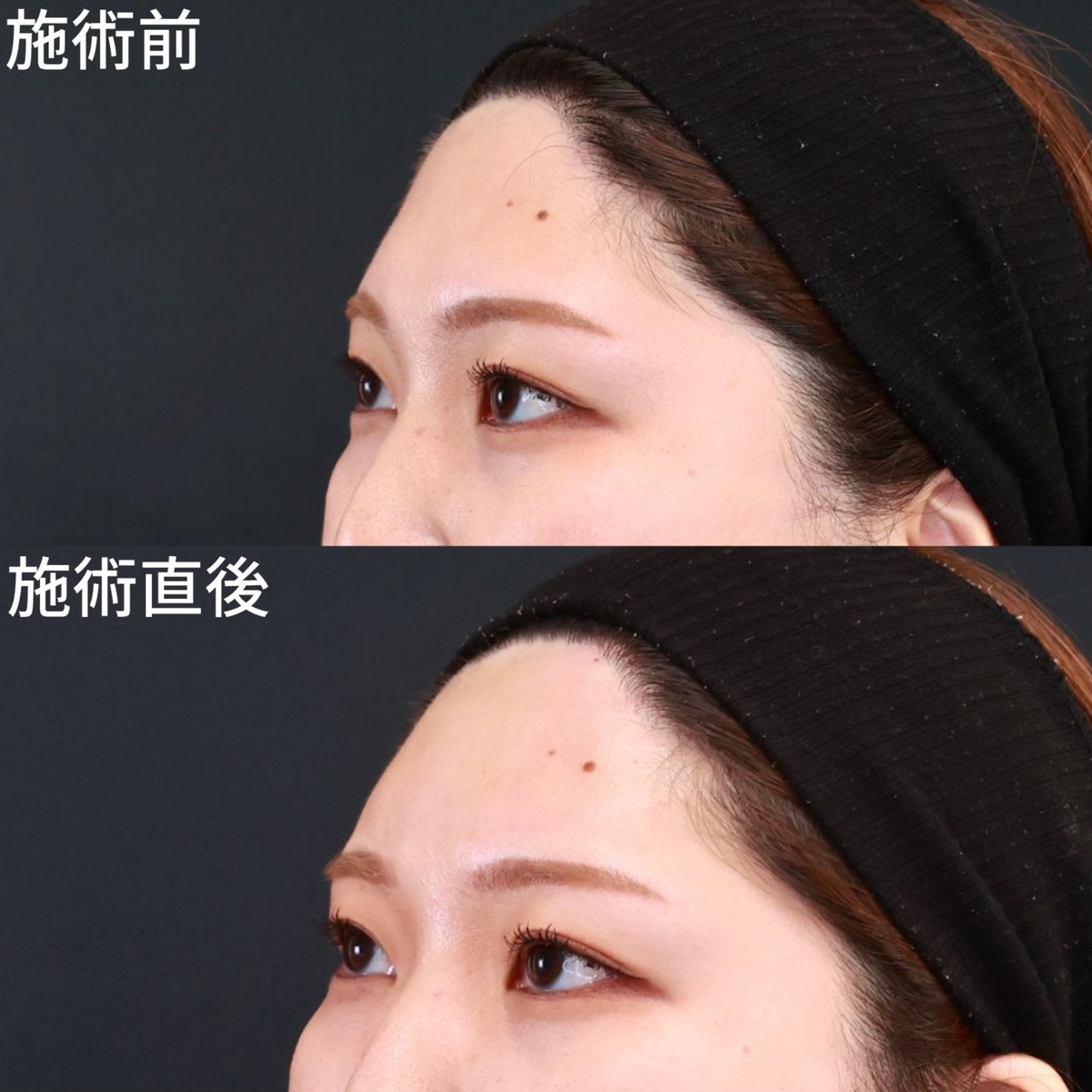 おでこ・こめかみのヒアルロン酸注射の症例写真 施術前後