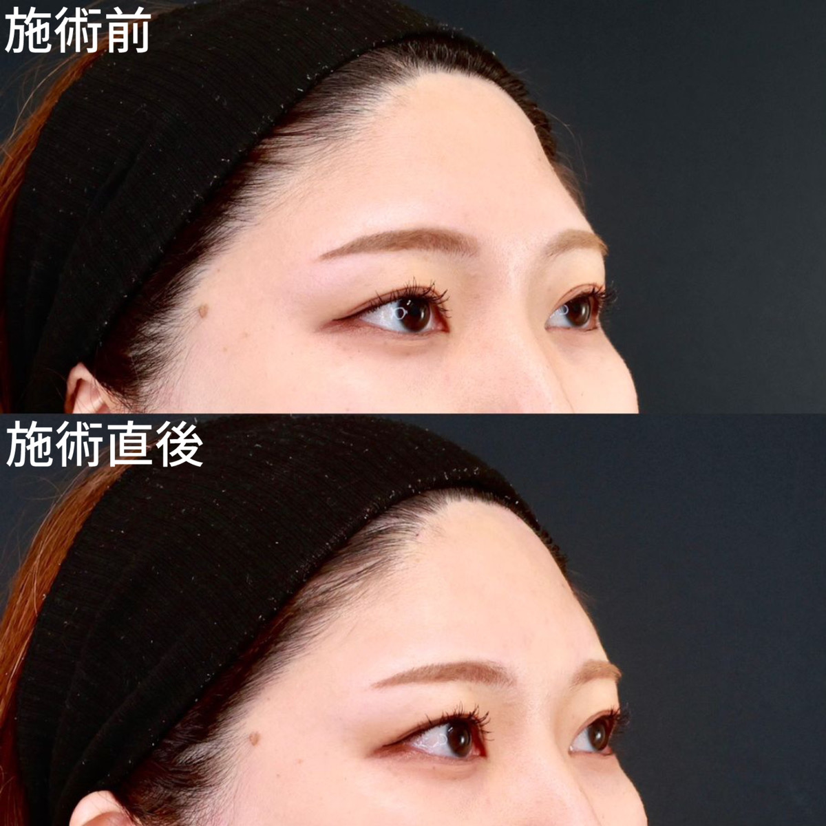 【おでこヒアルロン酸】即効でおでこの凹みを解消！柔らかい雰囲気に◎