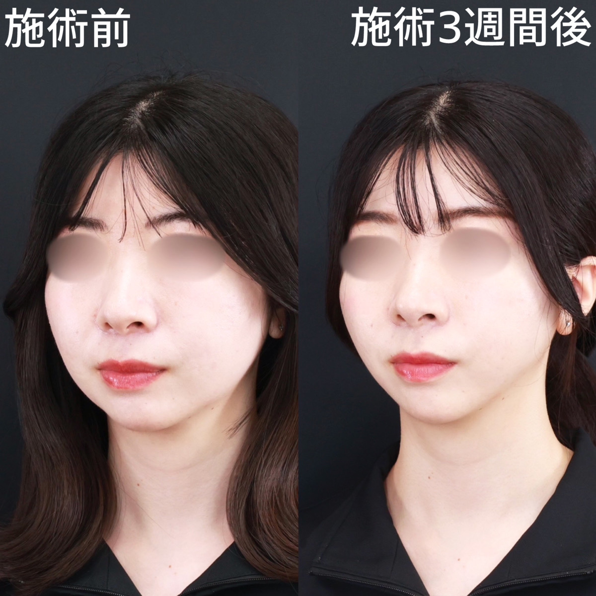 TAC式 ツヤ肌コラーゲンリフト®/ジョールファット除去/エラボトックス注射の症例写真 施術前後
