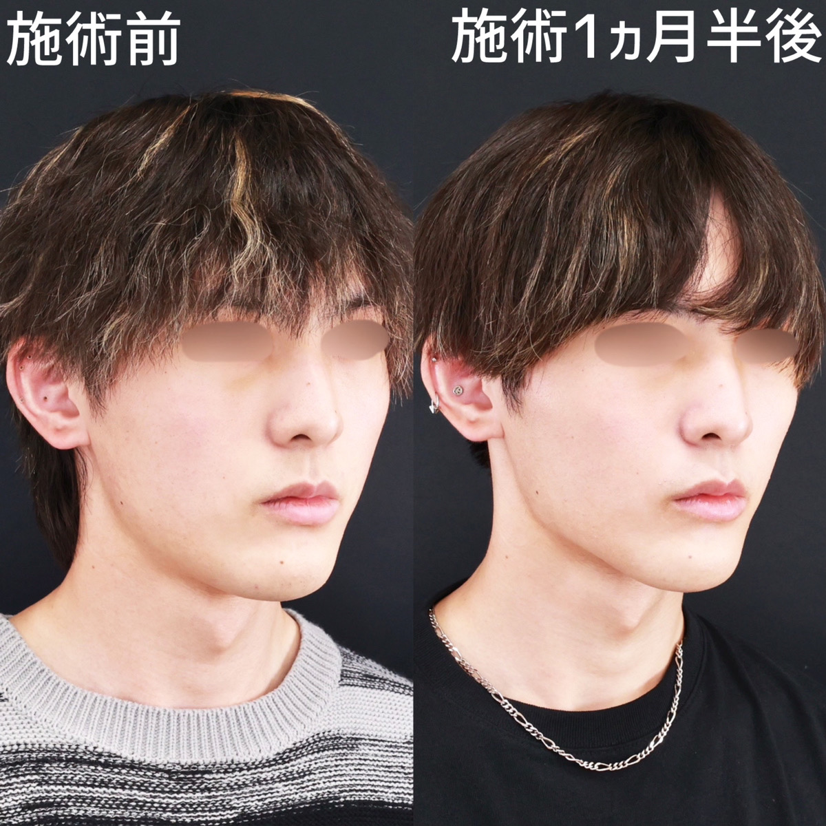 【Lラインファット除去×糸リフト極】クッキリと影が出るほど際立つ輪郭に！