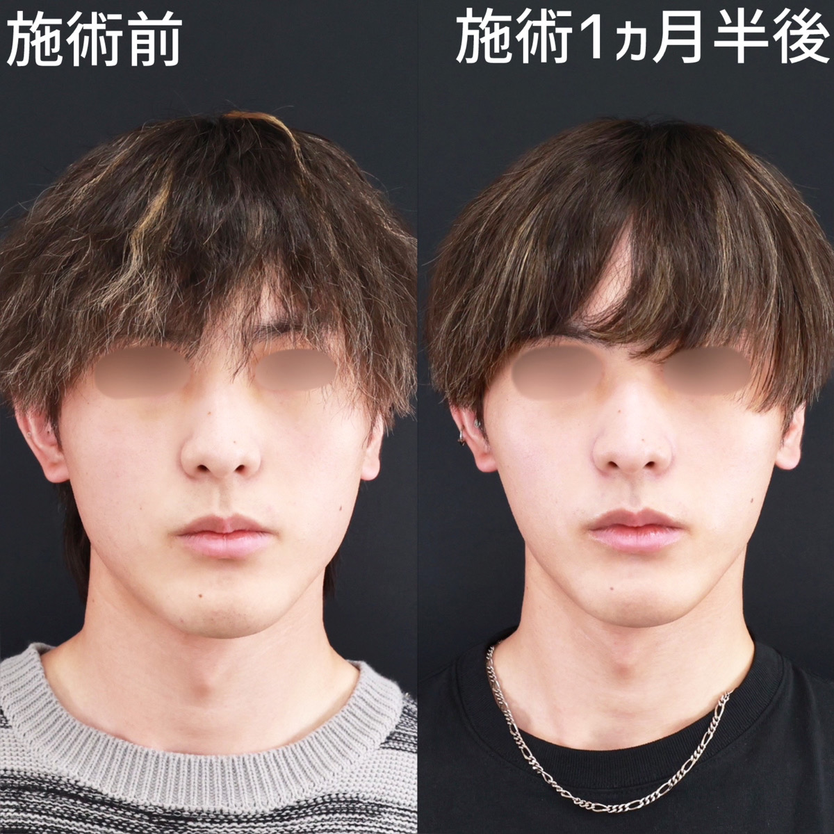 TAC式 ツヤ肌コラーゲンリフト®/Lラインファット除去（エラ下脂肪除去）/エラボトックス注射の症例写真 施術前後 