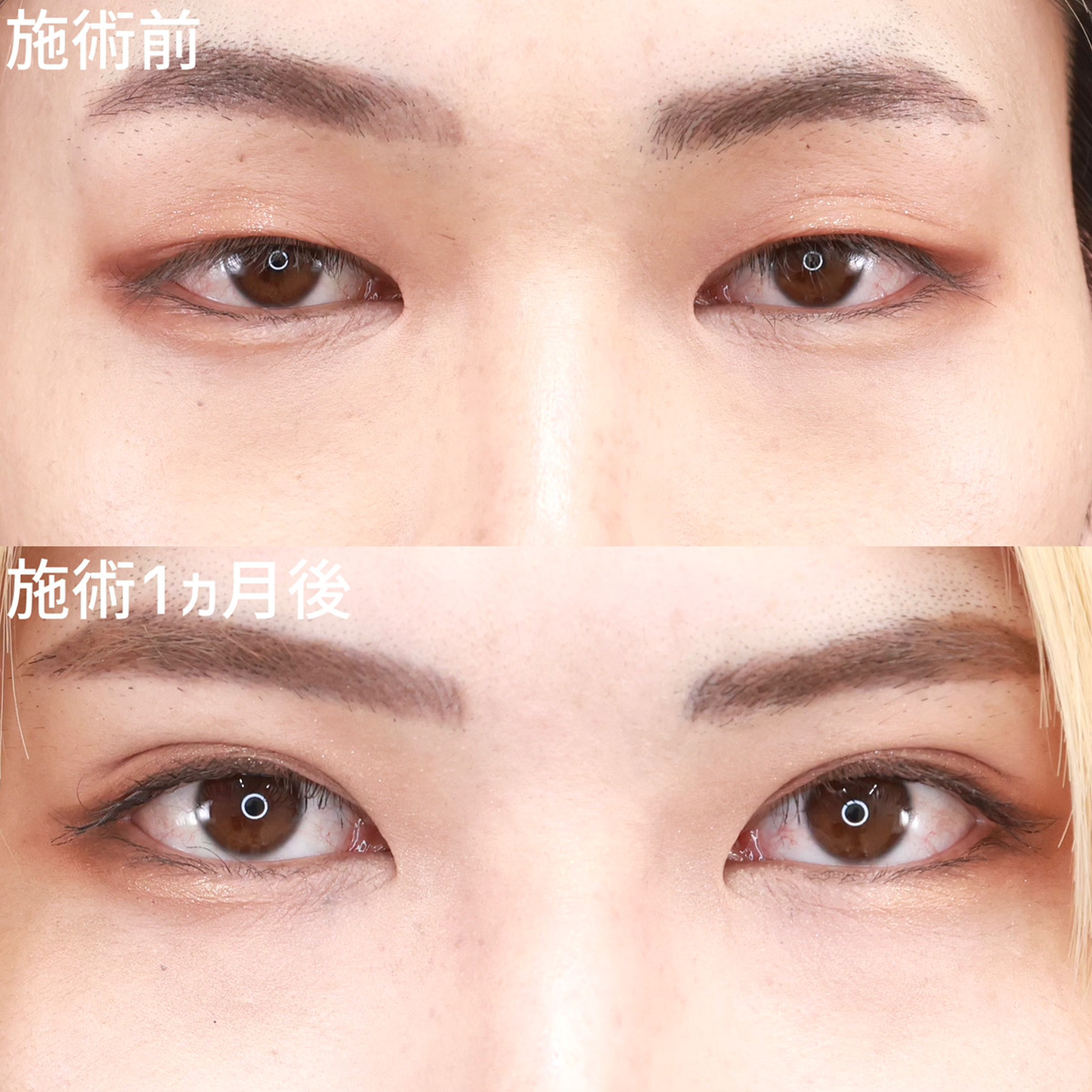 【クイックコスメリング】キリッと感を出すメンズの二重整形！