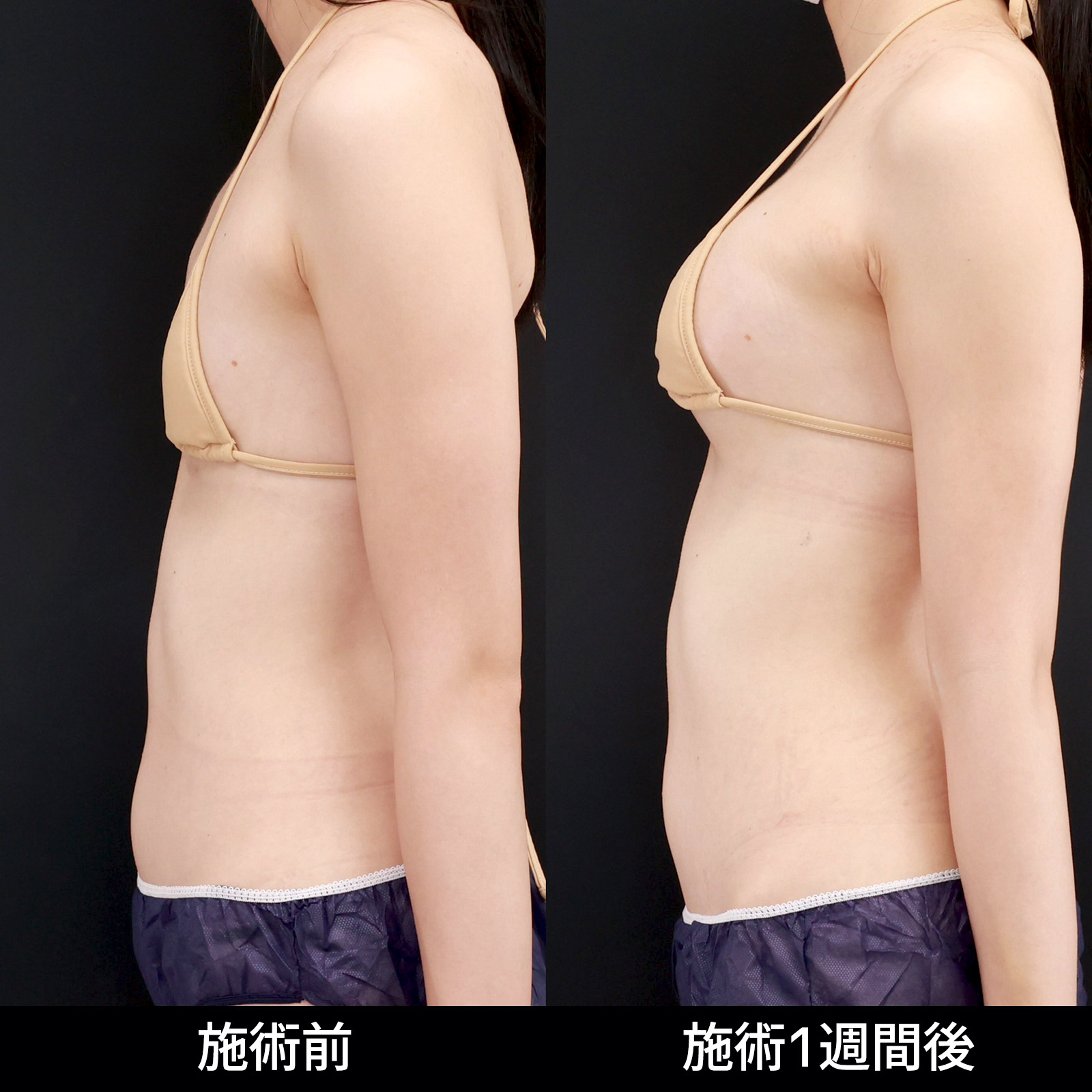 脂肪注入豊胸（コンデンスリッチ・ピュアグラフト・１day脂肪豊胸）の症例写真 施術前後 