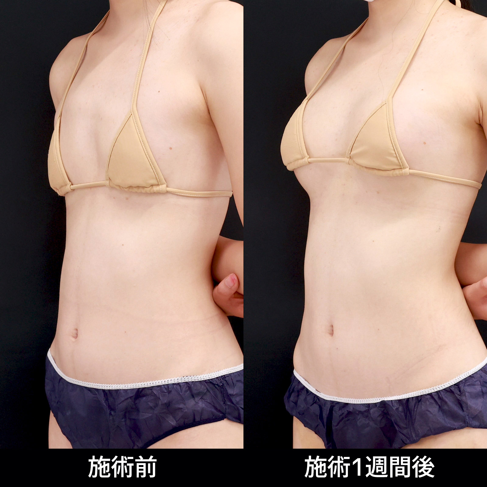 【脂肪注入豊胸】見た目はもちろん、触り心地に拘りたい方におすすめ!