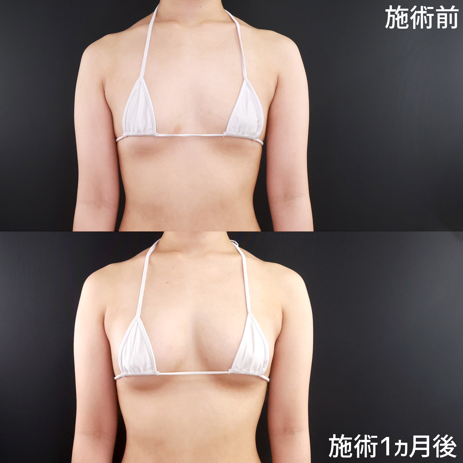 【コンデンスリッチ脂肪注入豊胸】パートナーにもバレにくい!?ふんわり柔らかなバストを形成