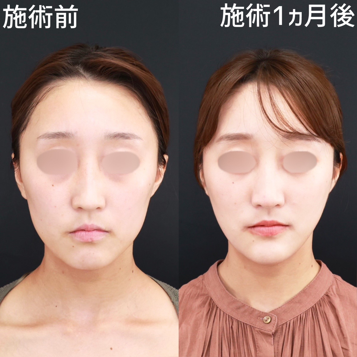 小顔整形|パーフェクトフェイスライン/TAC式 ツヤ肌コラーゲンリフト®/ジョールファット除去の症例写真 施術前後