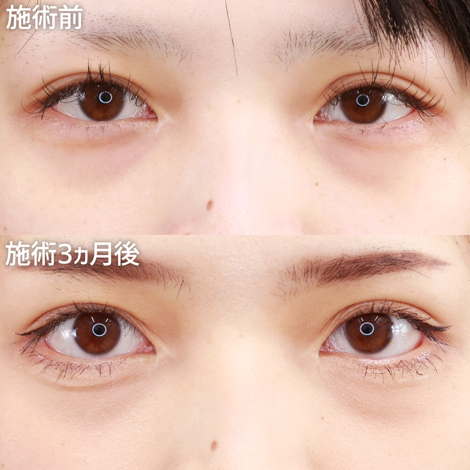 グラマラスライン（タレ目形成）の症例写真 施術前後 