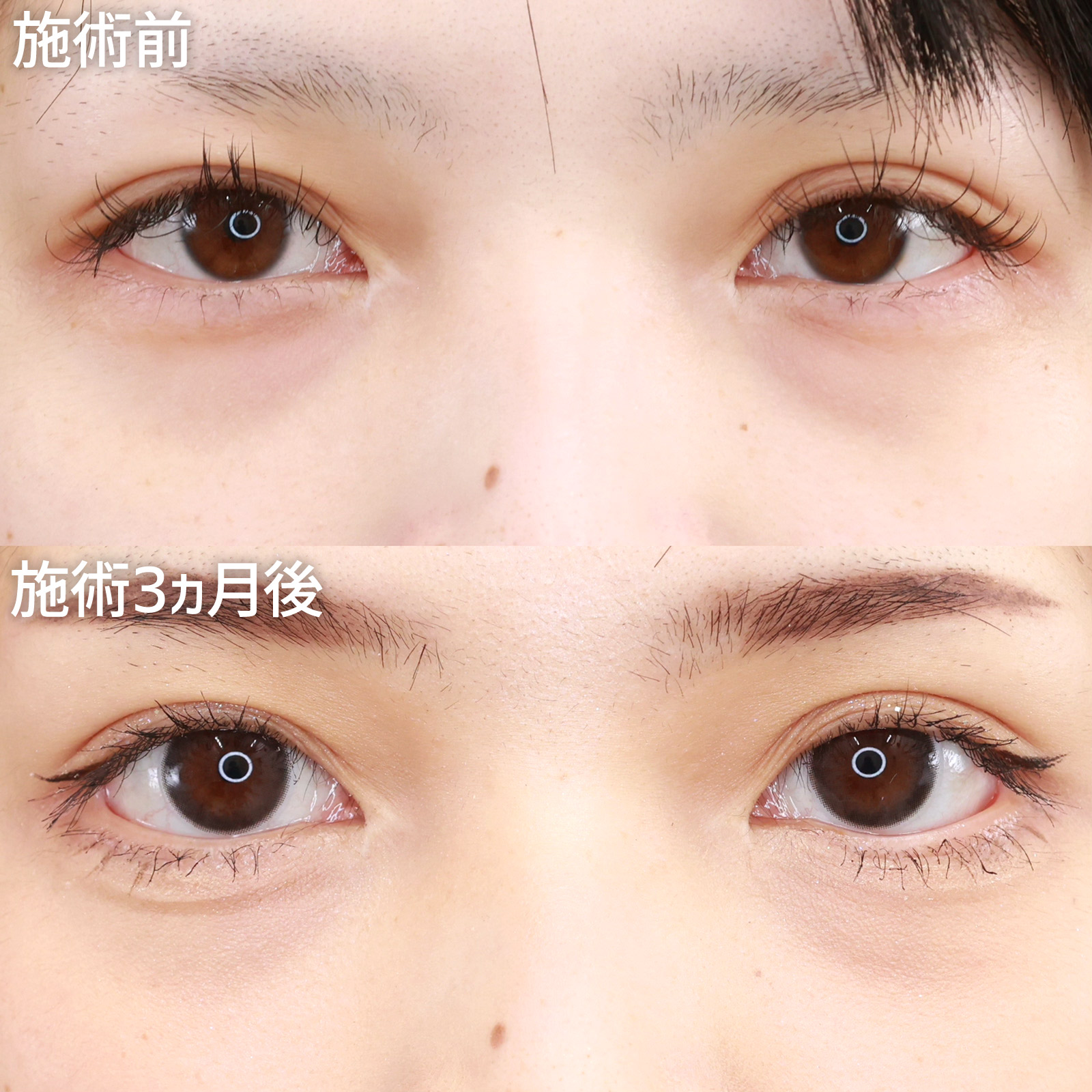 【グラマラスライン切開】隠れていた白目を露出させて、目に縦に拡大！