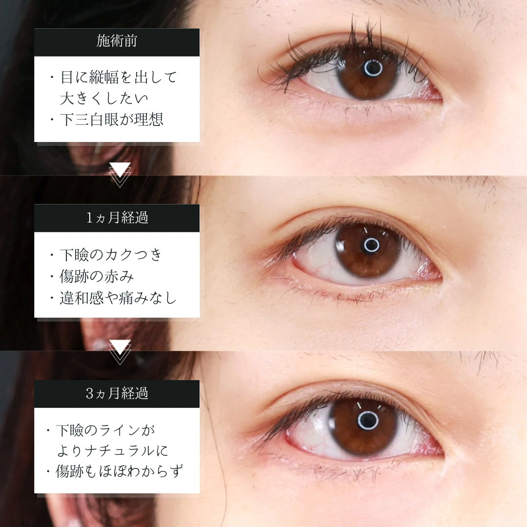 グラマラスライン（タレ目形成）の症例写真 施術前後 