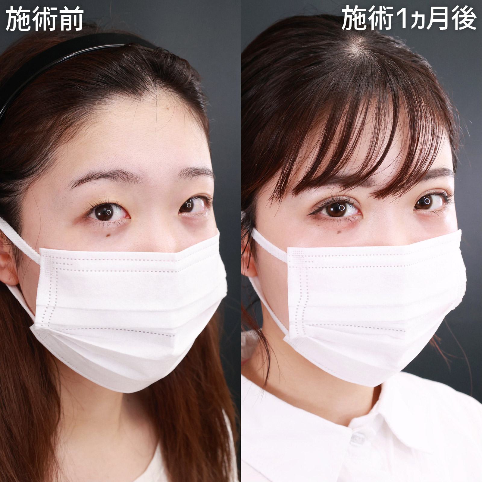 クイックコスメリングの症例写真 施術前後 