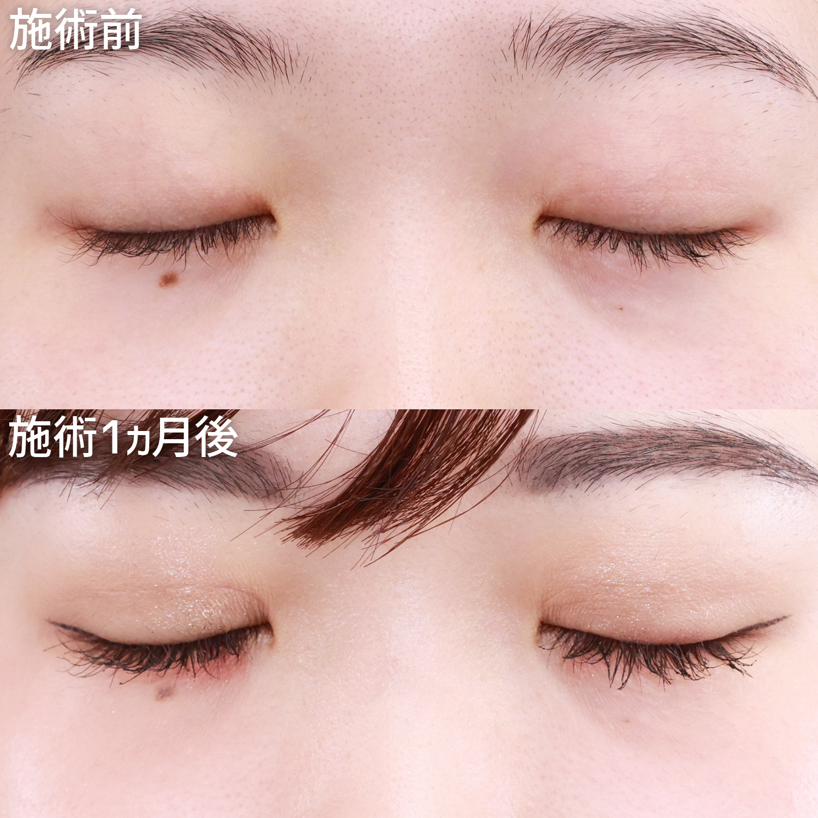 クイックコスメリングの症例写真 施術前後 