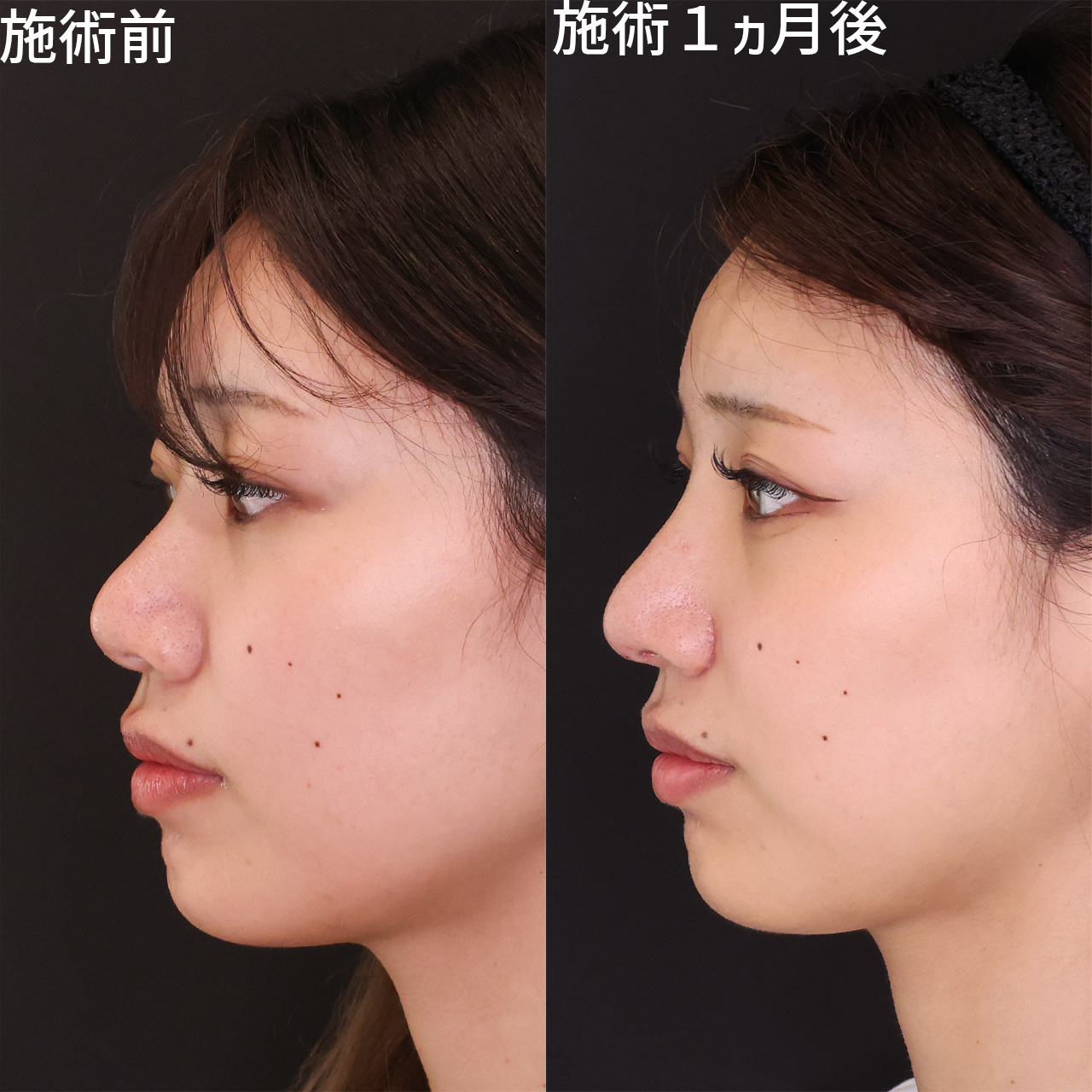 整形感を出さずに鼻洗練させる。鼻中隔延長で団子鼻改善