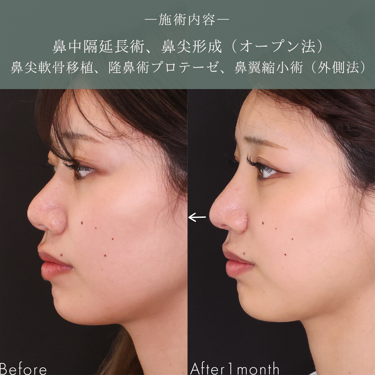 鼻中隔延長術/鼻尖形成・鼻尖縮小/TAC式 鼻翼縮小術（小鼻縮小）の症例写真 施術前後 