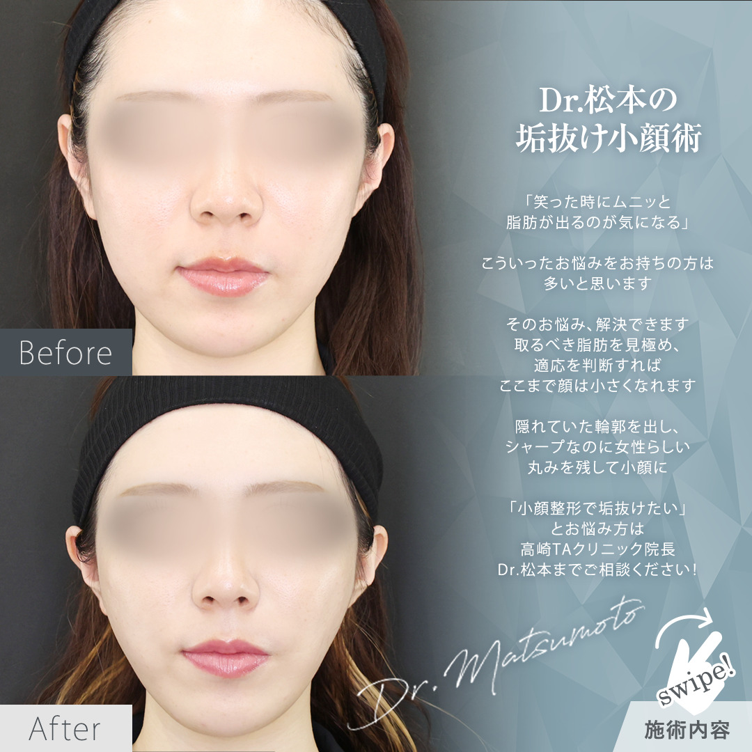 TAC式 ツヤ肌コラーゲンリフト®/バッカルファット除去/Lラインファット除去(エラ下脂肪除去)の症例写真 施術前後