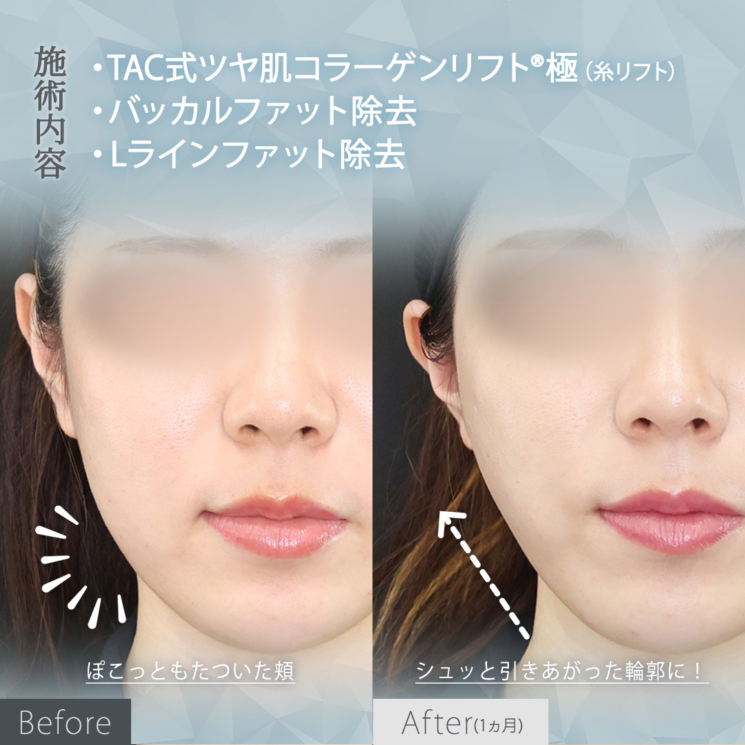 TAC式 ツヤ肌コラーゲンリフト®/バッカルファット除去/Lラインファット除去(エラ下脂肪除去)の症例写真 施術前後