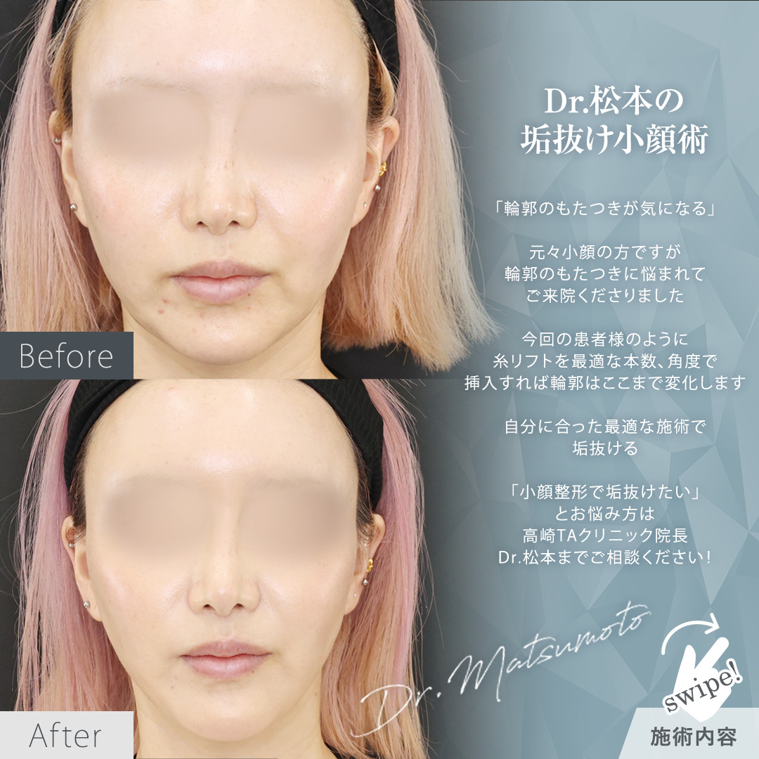 TAC式 ツヤ肌コラーゲンリフト®の症例写真 施術前後