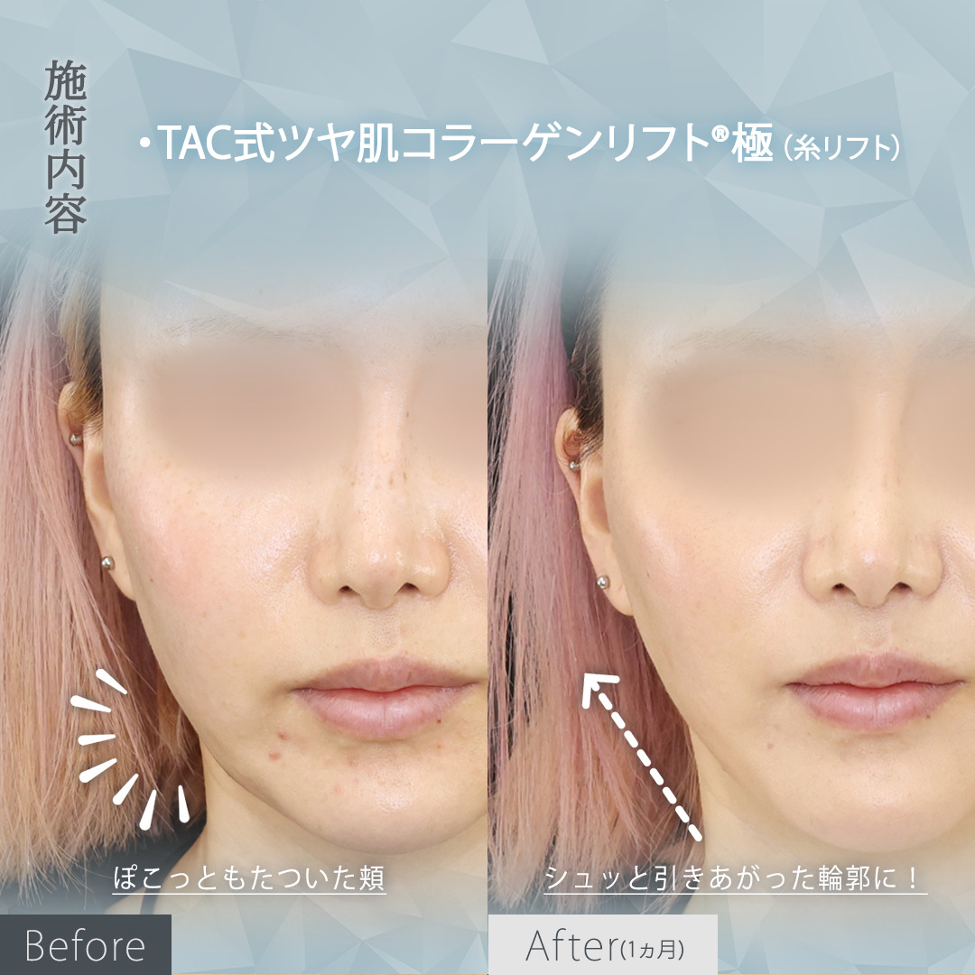 TAC式 ツヤ肌コラーゲンリフト®の症例写真 施術前後