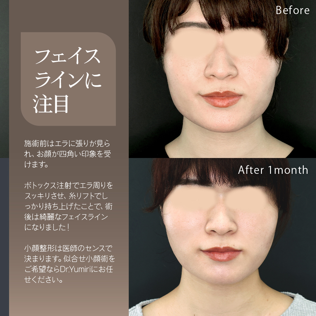 TAC式 ツヤ肌コラーゲンリフト®/エラボトックス注射の症例写真 施術前後 